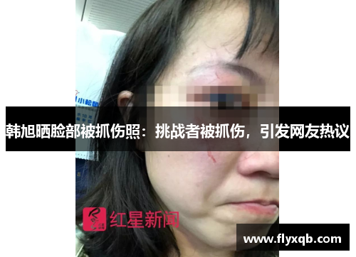 韩旭晒脸部被抓伤照:挑战者被抓伤,引发网友热议